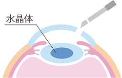 角膜切開